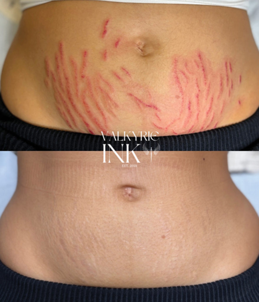 permanent makeup scar removal results