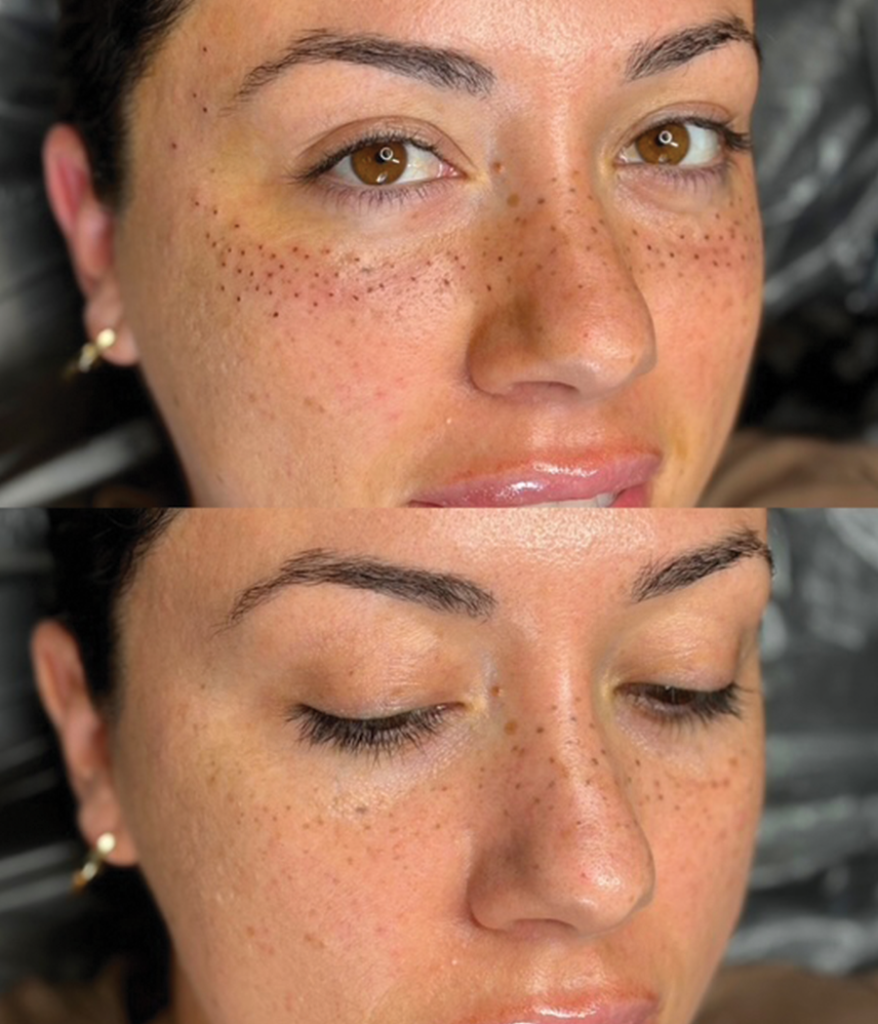 Permanent makeup freckles close up